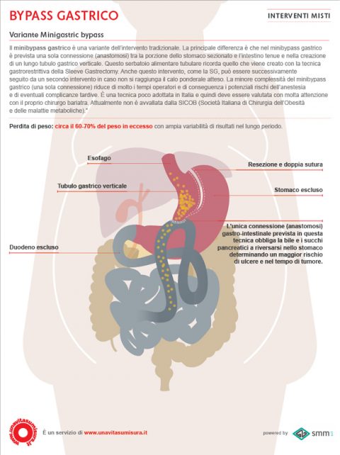 Bypass Gastrico - Variante Minigastric Bypass - Una Vita Su Misura