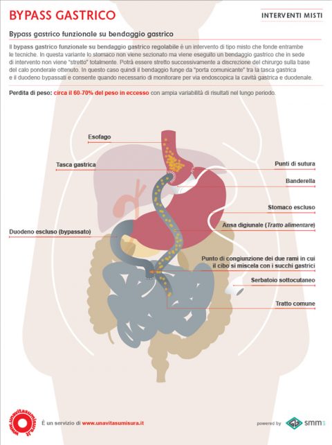 Bypass Gastrico Funzionale Su Bendaggio Gastrico - Una Vita Su Misura