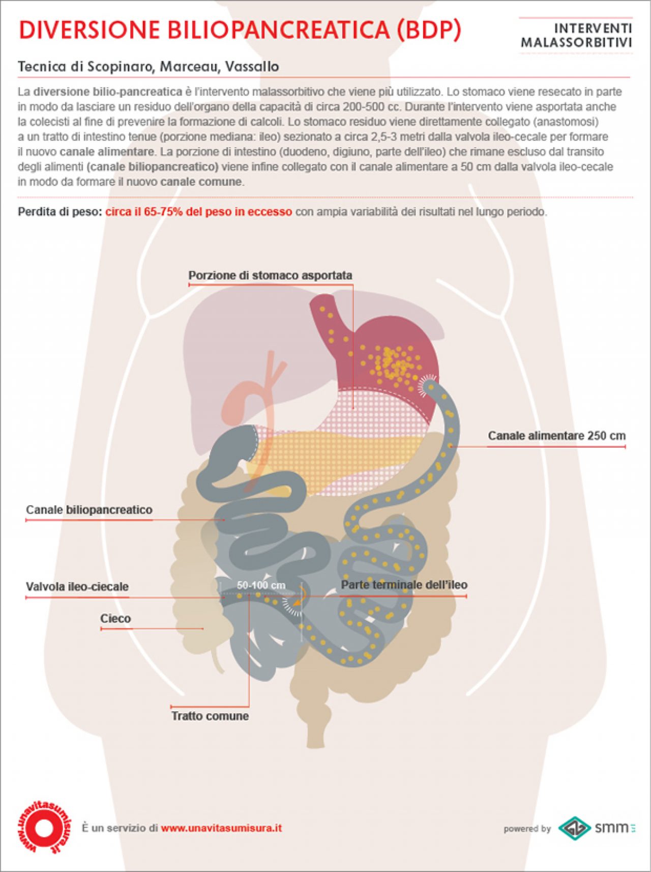 bypass gastrico per perdita di peso del primo meses bypass gastrico per perdita di peso del primo meses